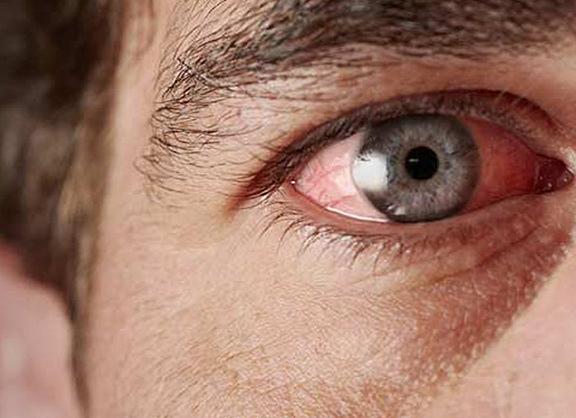 Почему болят глаза после сварки